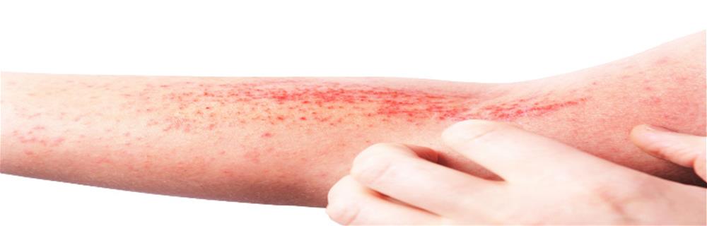 Skin Inflammatory Diseases