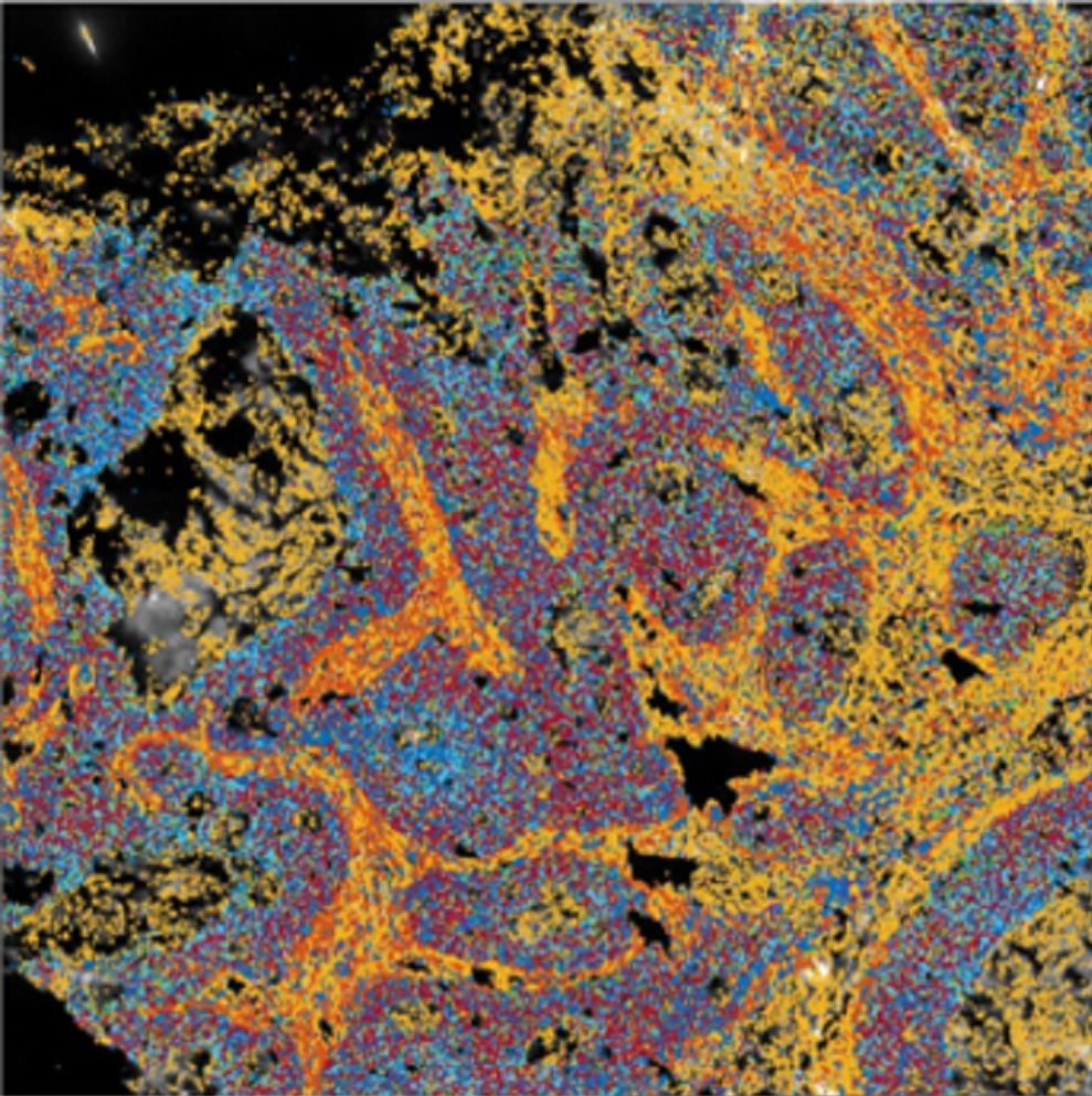 Spatial gene expression map in a colorectal tumour sample sq