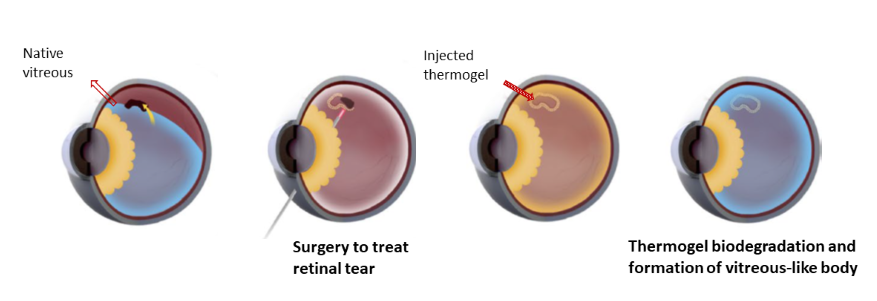 2020 12 15 Nature Biomedical Engineering - schematic of thermogel as vitreous substitute(resized)