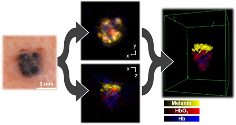 Real-time 3D imaging of non-melanoma skin cancer tumours