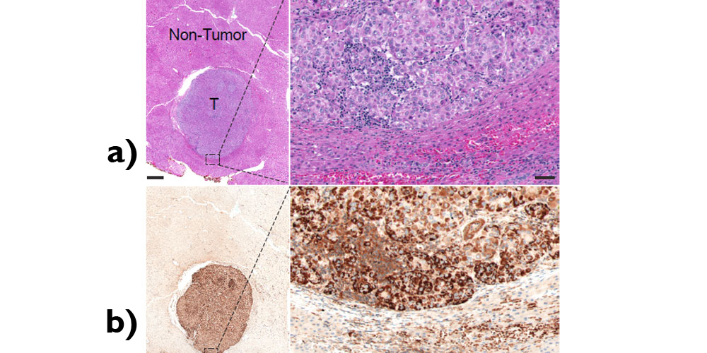 Singapore scientists reveal a metabolic pathway as a new target in liver cancer treatment