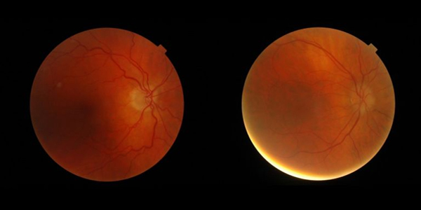 Using AI to interpret eye images for major health risks