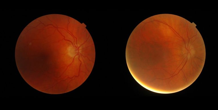 Using AI to interpret eye images for major health risks