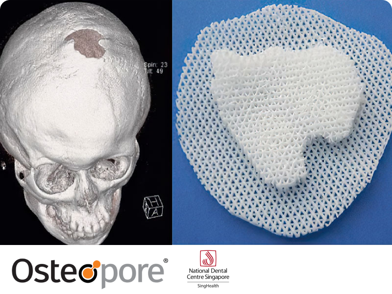 Functional Bone Regeneration - Osteopore