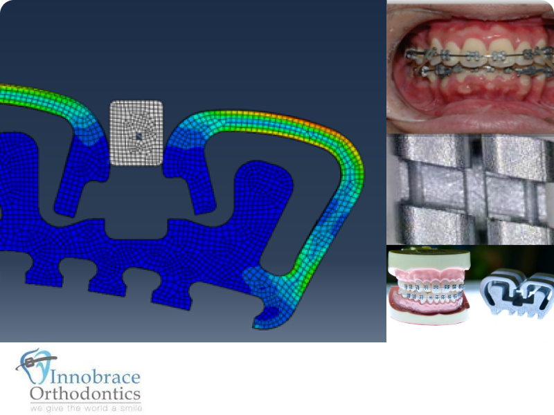Non-ligating Dental Bracket