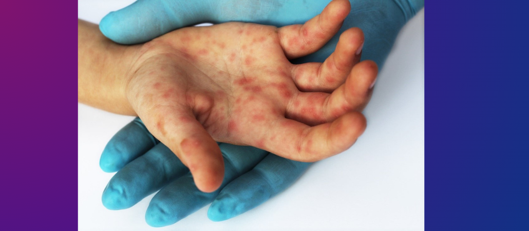hfmd4_banner