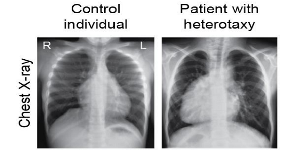 L-R Asymmetry In Body - thumbnail