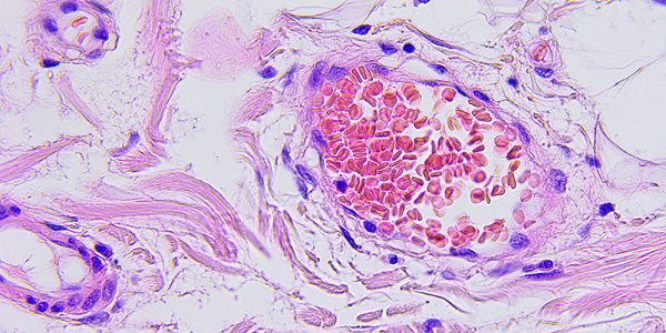 thumb_newclassificationforcolorectalcancer - thumbnail