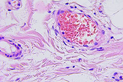 thumb_newclassificationforcolorectalcancer