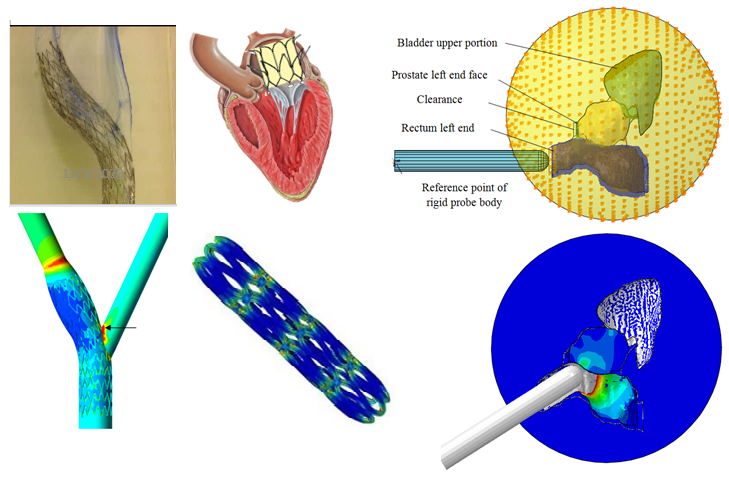 Carotid artery stent