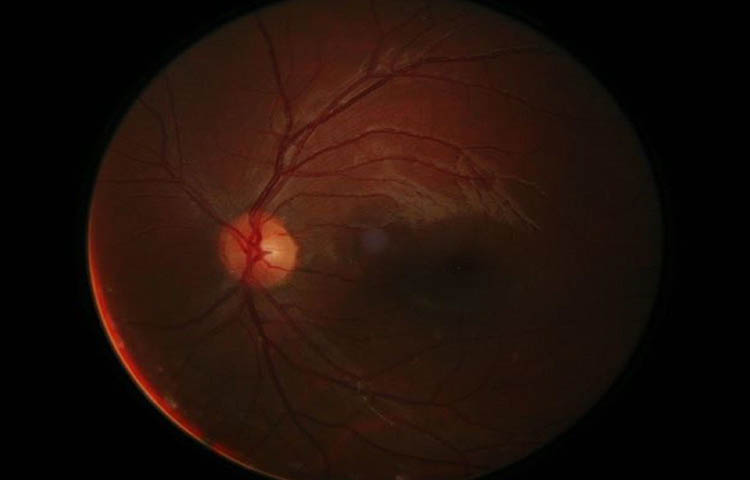 Eye Retinal_Cover