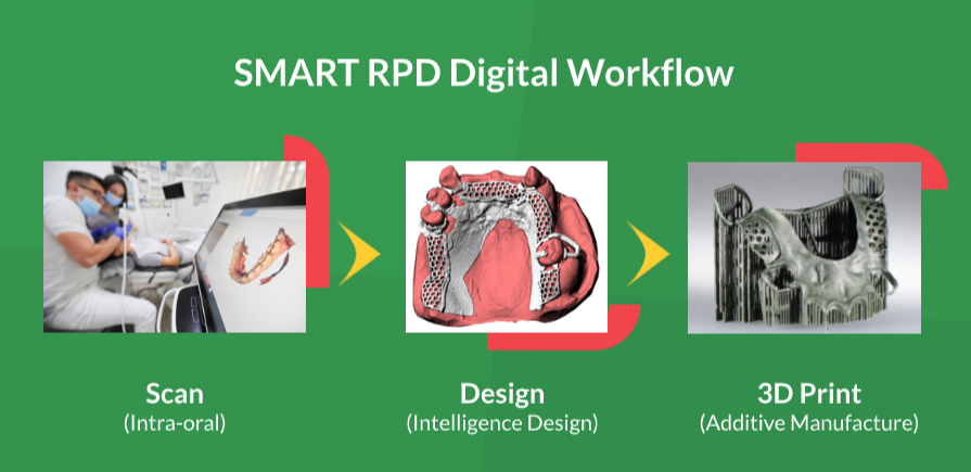 SMART RPD - Scan-Design-3D Print
