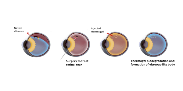 2020 12 15 Nature Biomedical Engineering - schematic of thermogel as vitreous substitute (600x300)