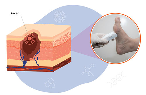 Haloflow for Prediction and Evaluation of Diabetic Foot Ulcers